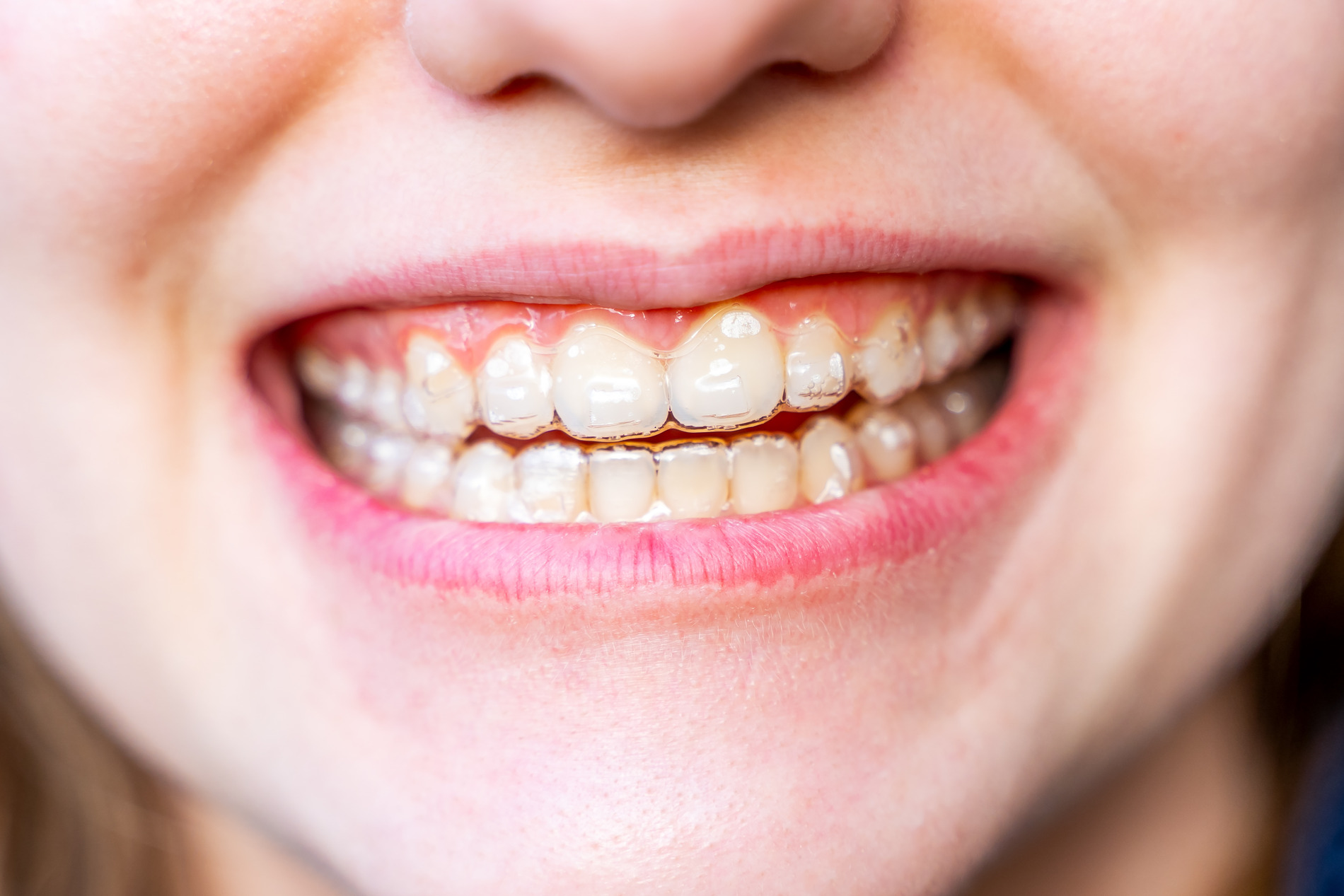 AdobeStock_743465151 v2 Girl has invisalign kid aligners in Crestview HIlls KY