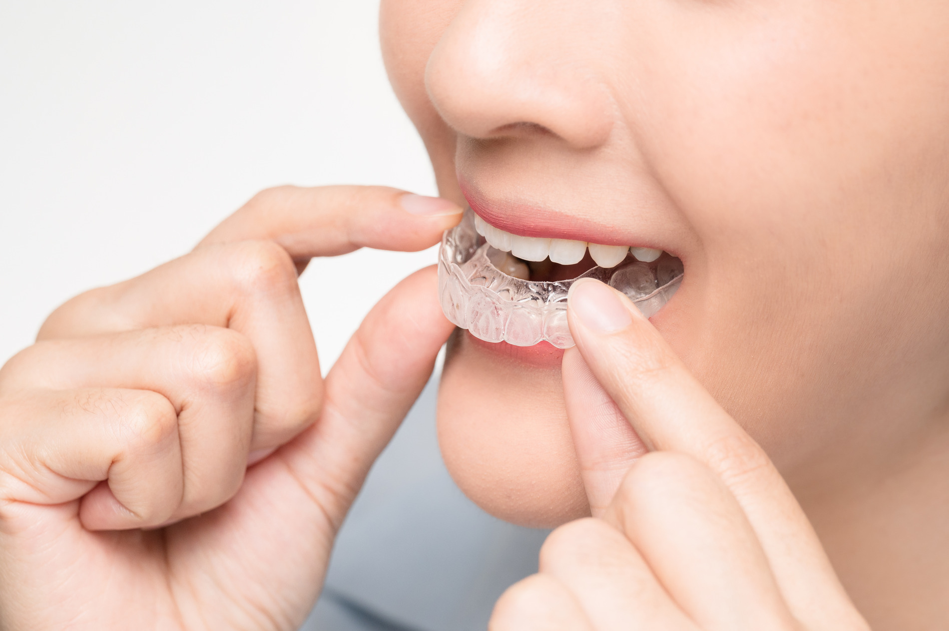 AdobeStock_438400677 v2 Woman putting in her limited invisalign treatment in Crestview Hills KY