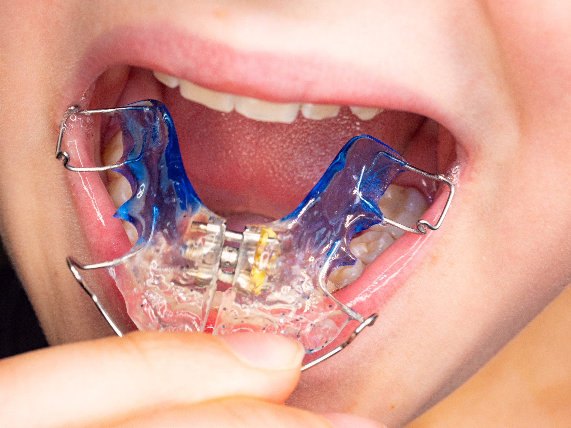 Teen places their marpe expander in theri mouth