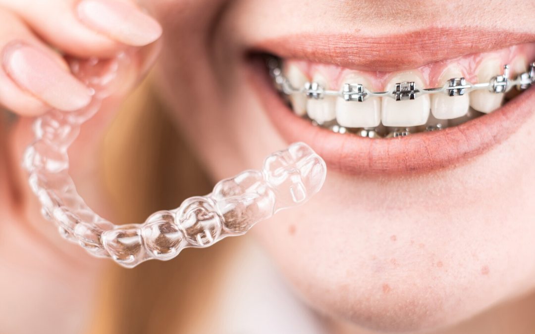 Understanding the Cost of Braces and Invisalign in Crestview Hills, KY