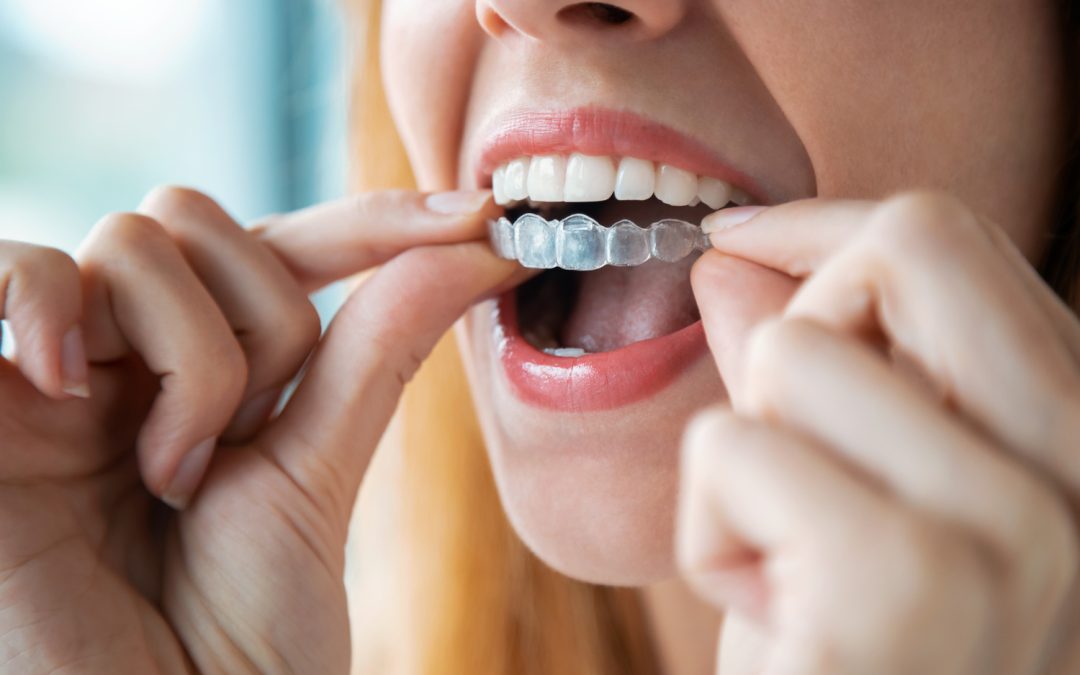 Invisalign Care and Daily Routine: Cleaning, Wearing, and Maintenance