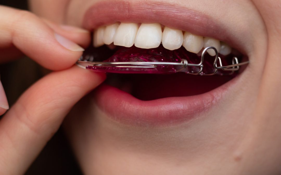 After Braces or Invisalign: Why Retainers Matter in Crestview Hills, KY