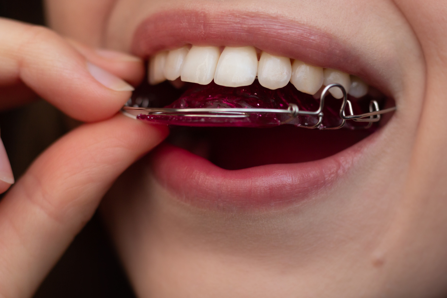 Girl puts in her retainer in Crestview Hills KY